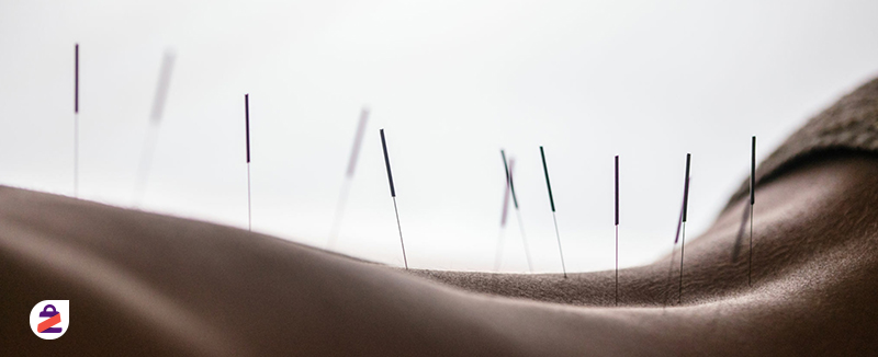 درمان کمر درد با طب سوزنی