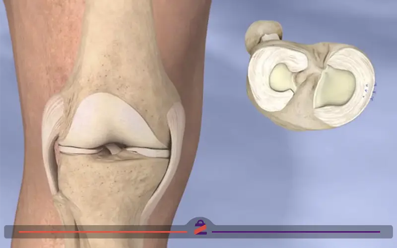 قفل شدن غضروف زانو آنوتومی