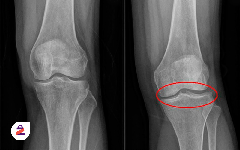 تصویر رادیولوژی از یک آرتروز زانو