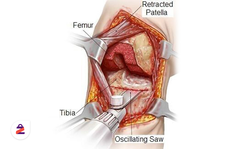 تصویری از آنوتومی آرتروز زانو