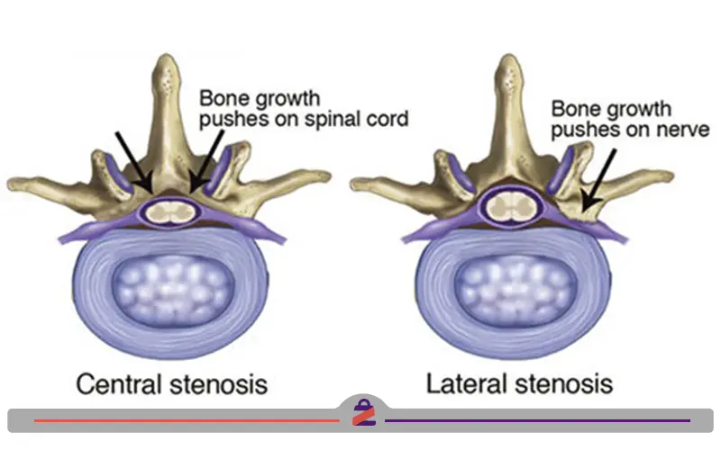 تصویر از آنتومی اسپوندیلوز