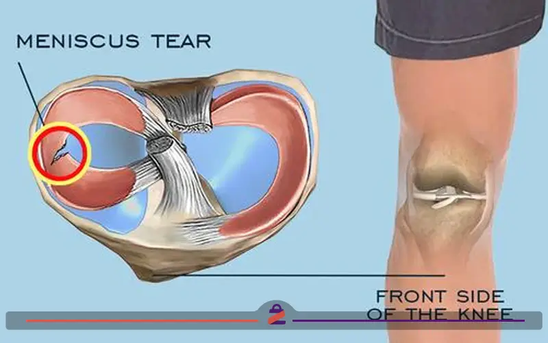 آنوتومی پارگی مینیسک زانو