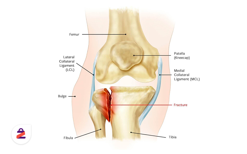 آنوتومی شکستگی مفصل زانو
