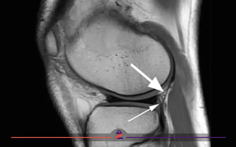 تصویر رادیولوژی از پارگی مینیسک زانو