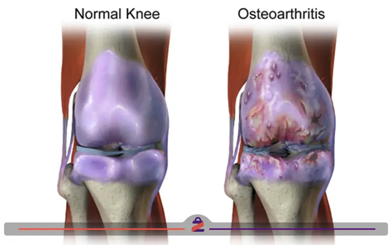 تصویری از بیماری استئوآرتریت