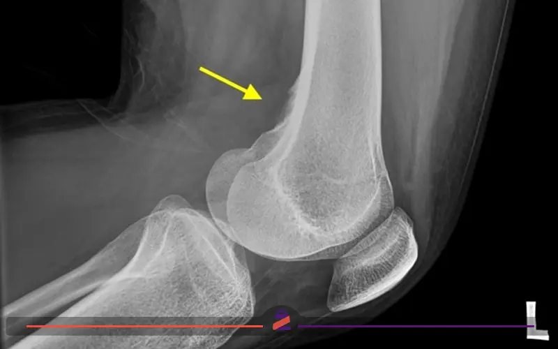 عکس رادیولوژی خار زانو
