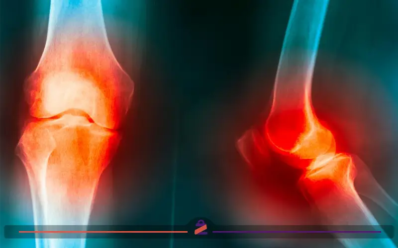 ویتامین D برای درمان زانو درد