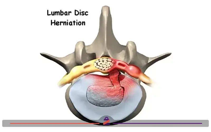 تاثیر کمربند بر روی دیسک کمر چگونه است؟