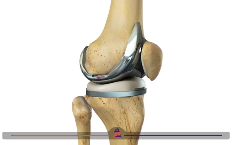 ساختار پلاتین در زانو