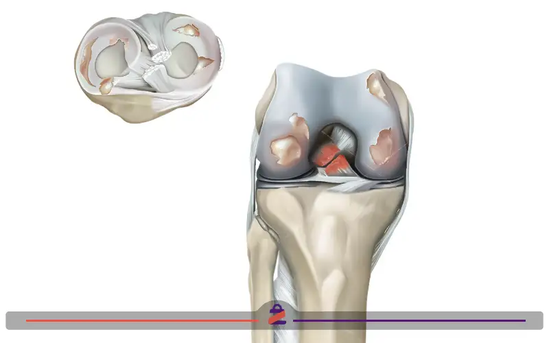 آرتریت زانو بعد از دویدن