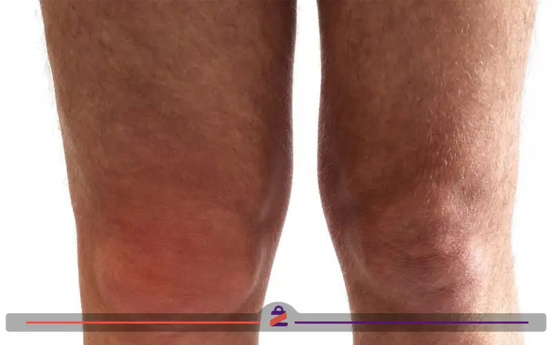 ورم زانو از نشانه های سرطان زانو